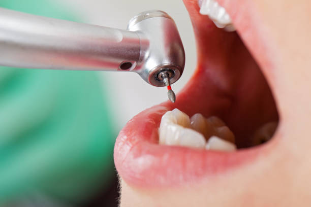 Best Emergency Dental Care for Broken or Chipped Teeth in Marion, OH